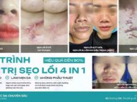 điều trị sẹo lồi tại dr choice clinic
